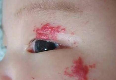 婴儿有血管瘤危险吗,3个方法让宝妈孕期预防血管瘤