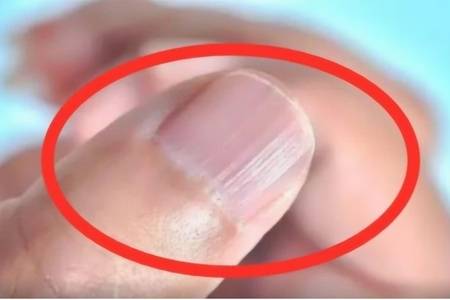 指甲上有竖纹是怎么回事,教你改善指甲竖纹的方法