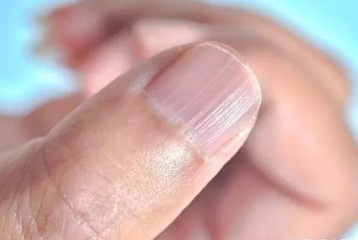 指甲上有竖纹是什么原因怎么回事：解决办法分享