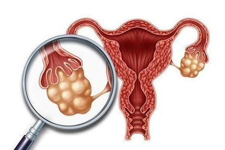 女人卵巢囊肿缠身的两大危害