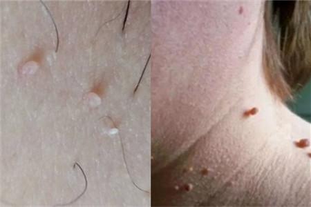 别找了！脖子上长小肉疙瘩的原因,无非就是这6个！