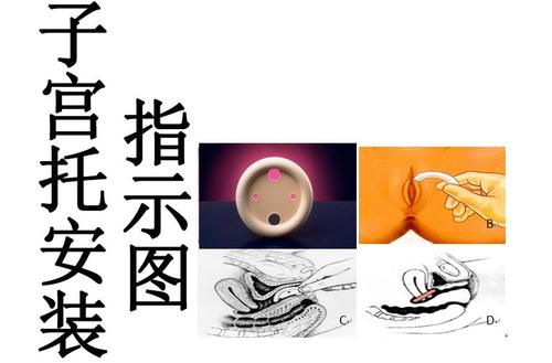 顺产后前壁膨出怎么办