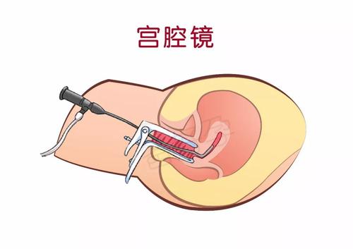 宫腔镜手术多久恢复3 宫腔镜手术多久恢复