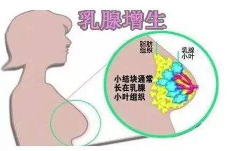 乳腺增生的症状 乳腺增生的两大危害