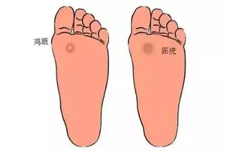 鸡眼是什么 治疗鸡眼的四个方法