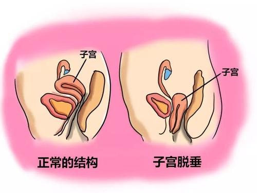 子宫下垂是什么样子