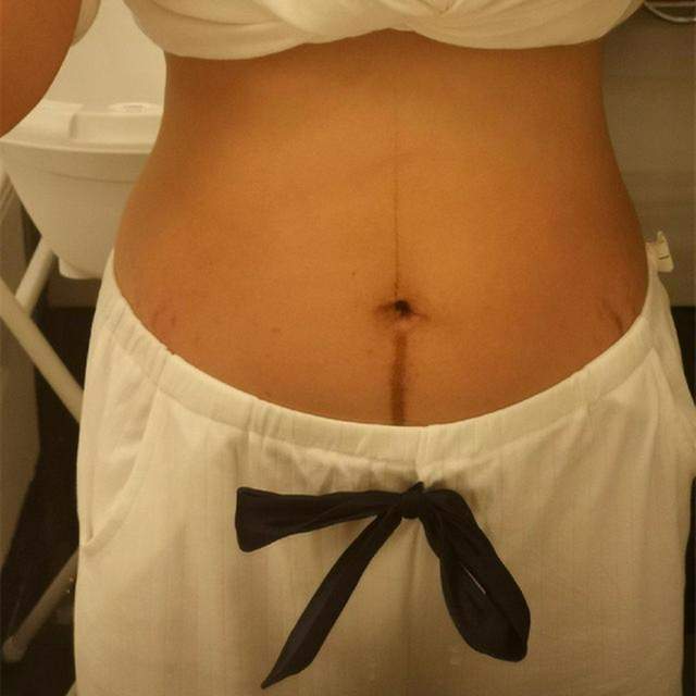 怀孕后肚子上的“黑线”是什么？妊娠中线的秘密,你有必要了解