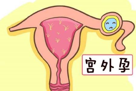 女人宫外孕的常见发病原因竟是它