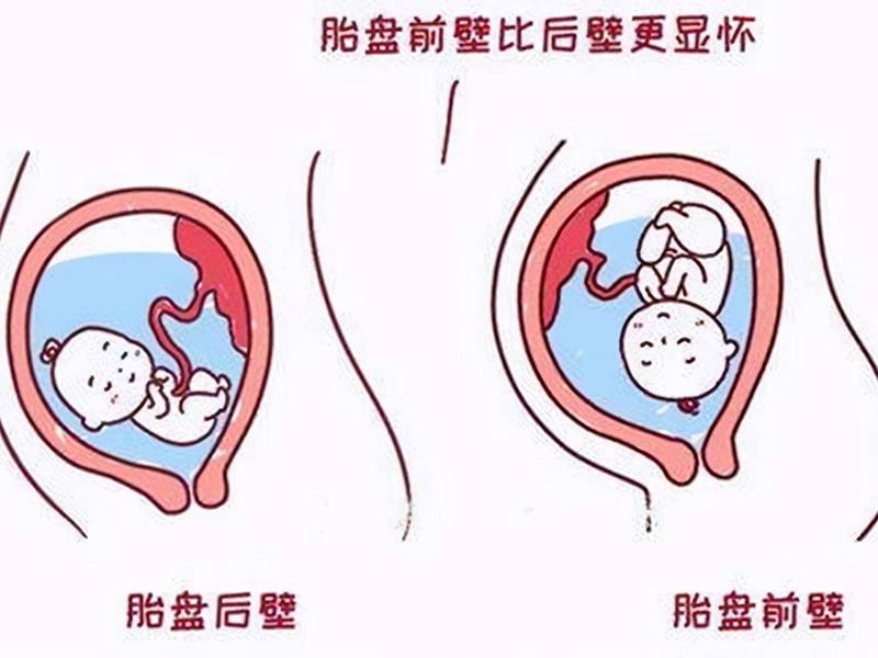 胎儿前壁好吗？孕妈早知早好！