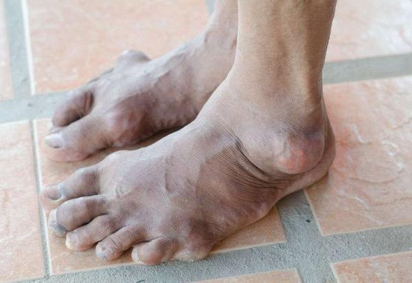 痛风来,睡觉知？睡觉时出现3个现象,暗示体内尿酸已经过高了！