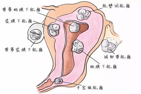 子宫肌瘤是什么原因导致的？预防子宫肌瘤的方法