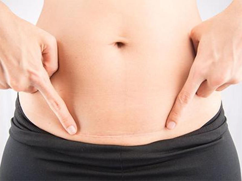 剖腹产是＂拆线＂好还是＂美容线＂好？哪种不会让疤痕增生？