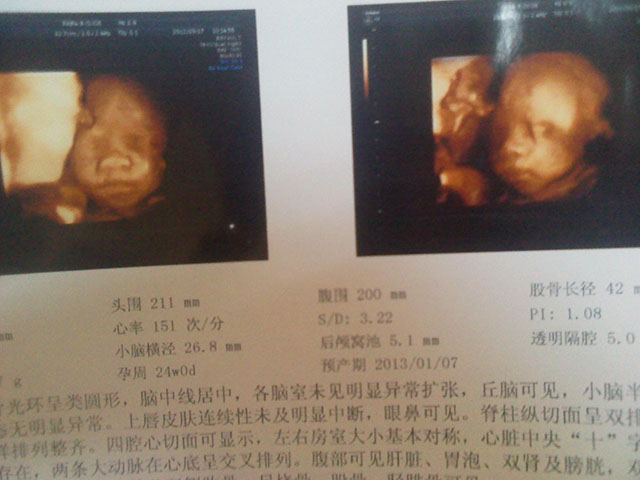 孕检需要做,但这3种实在没必要,不仅没什么大用,还费钱费时