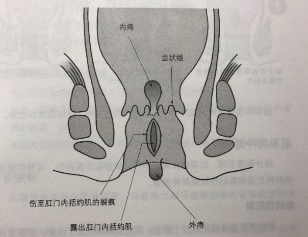 大便带血,到底是痔疮还是直肠癌？肛肠科医生教你准确判断