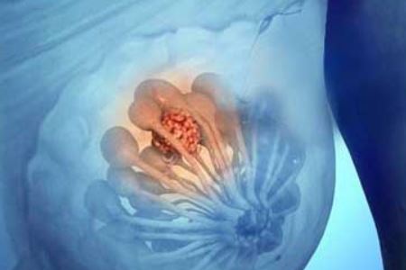 细说乳腺增生会变成乳腺癌吗