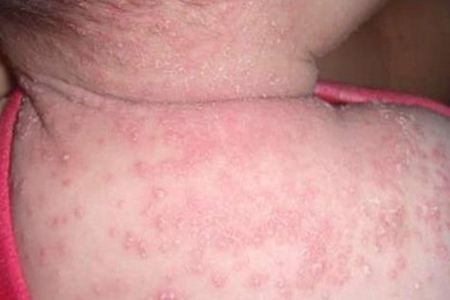 宝宝湿疹怎么处理最好办法？这四个宝宝湿疹最佳治疗方法
