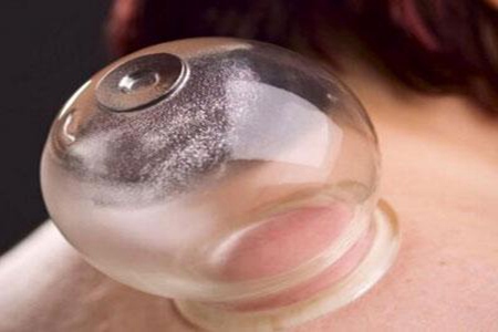 刮痧和拔罐的区别？女人湿气重刮痧好还是拔罐好