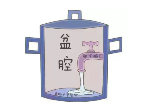 盆腔积液不重视,将会是女人噩梦的开始