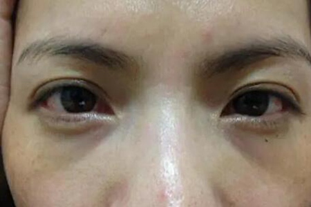黑眼圈重怎么快速消除？这四个去黑圈最有效的方法