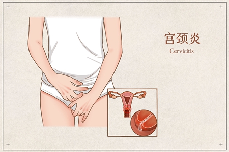 宫颈炎有什么危害？这些注意事项有效预防延缓疾病发生